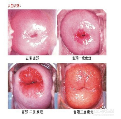 青春期宮血治療方法探討