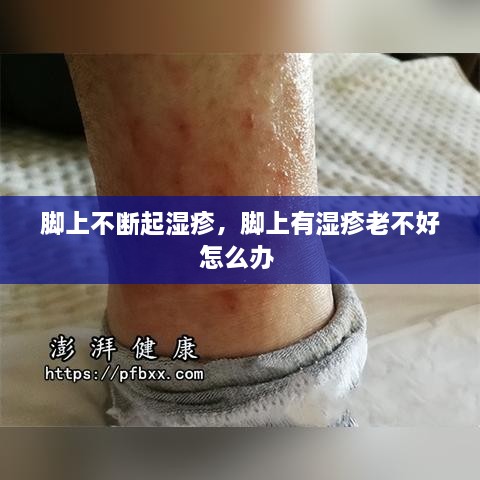 腳上不斷起濕疹，腳上有濕疹老不好怎么辦 