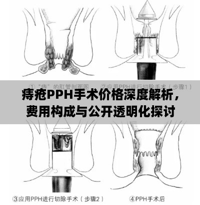 痔瘡PPH手術價格深度解析，費用構成與公開透明化探討