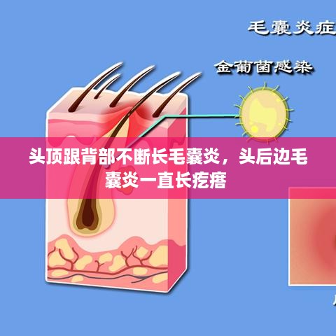 頭頂跟背部不斷長毛囊炎，頭后邊毛囊炎一直長疙瘩 